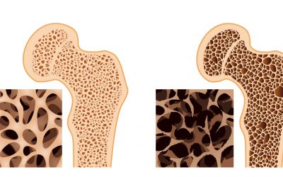 Osteodensitometrie osteopooza, test dexa, dexa, dxa, osteopenie, menopauza, test osteoporoza, osteodensitometrie, fractura os patologic, densitate minerala osoasa, os osteoporotic, coloana, sold, antebrat,